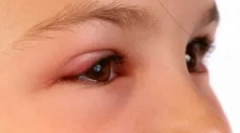 Čo robiť, ak midge padol alebo bite do oka